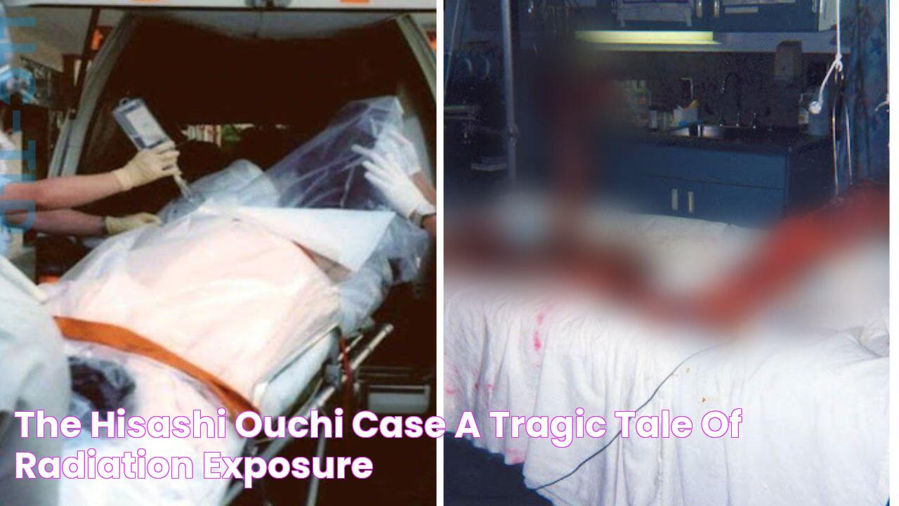 The Hisashi Ouchi Case A Tragic Tale Of Radiation Exposure