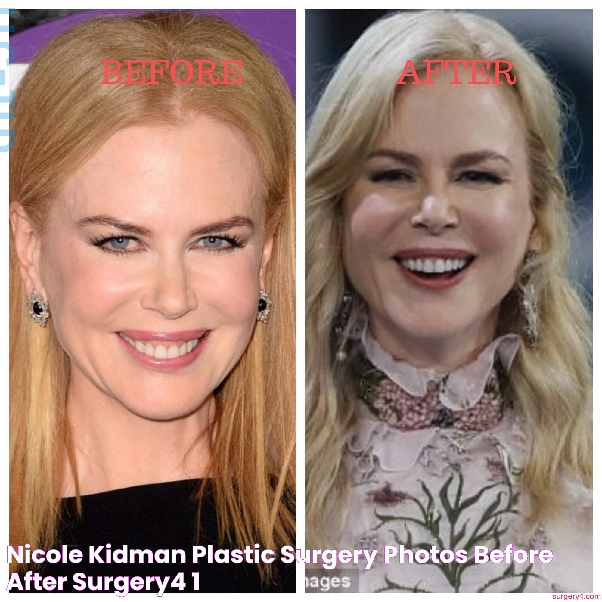 Unveiling Nicole Kidman's Journey With Cosmetic Surgery