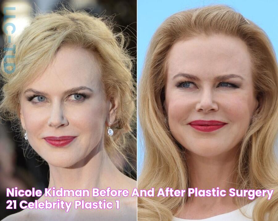 Nicole Kidman before and after plastic surgery (21) Celebrity plastic