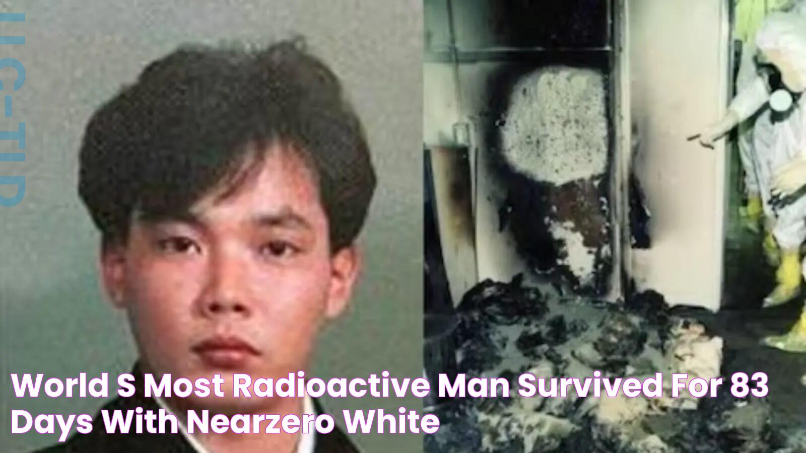 World's Most Radioactive Man Survived For 83 Days With NearZero White