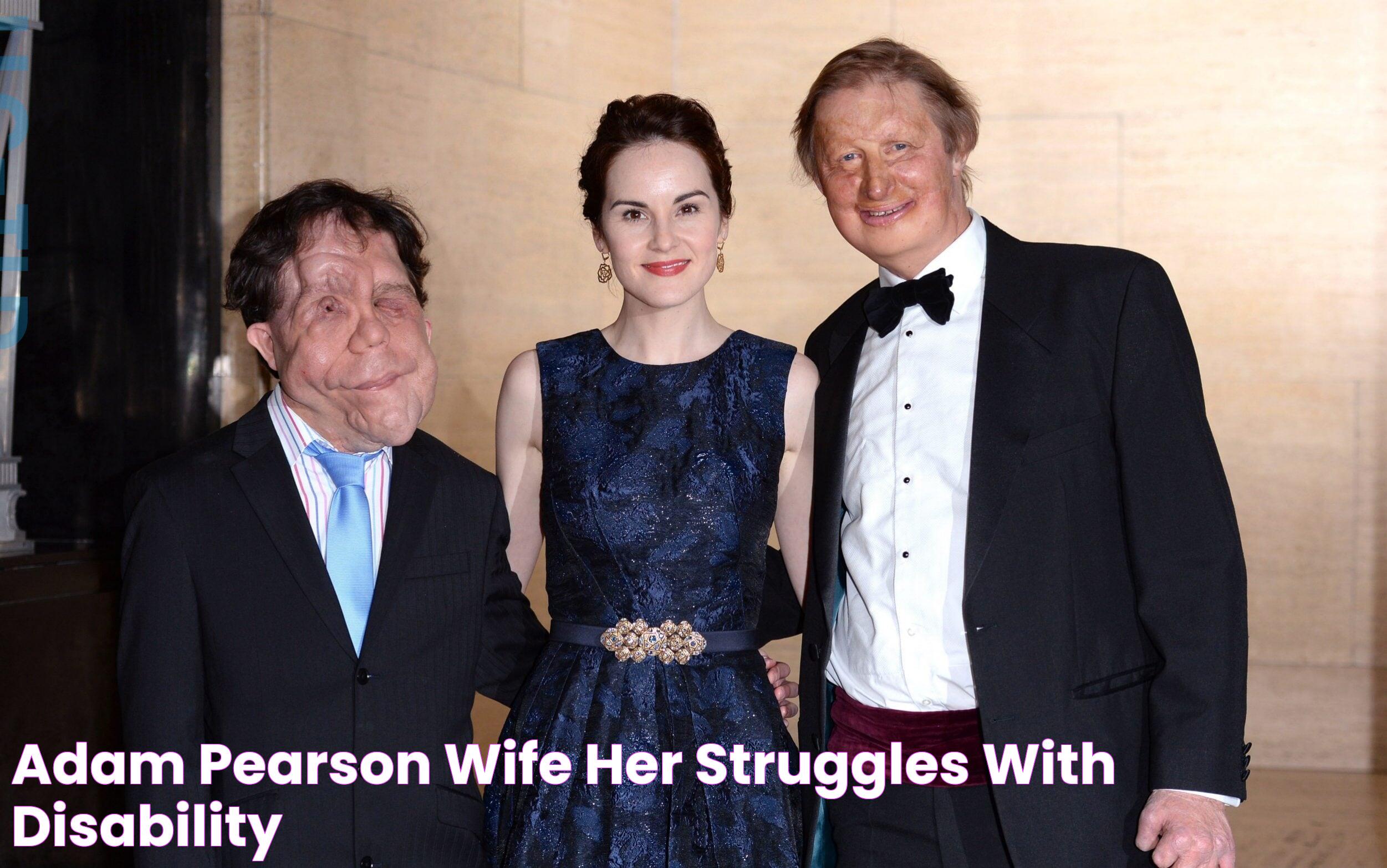 Adam Pearson Wife Her Struggles with Disability