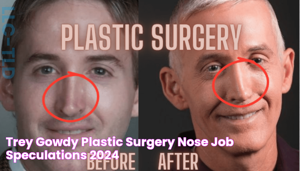 Trey Gowdy Plastic Surgery Nose Job Speculations 2024