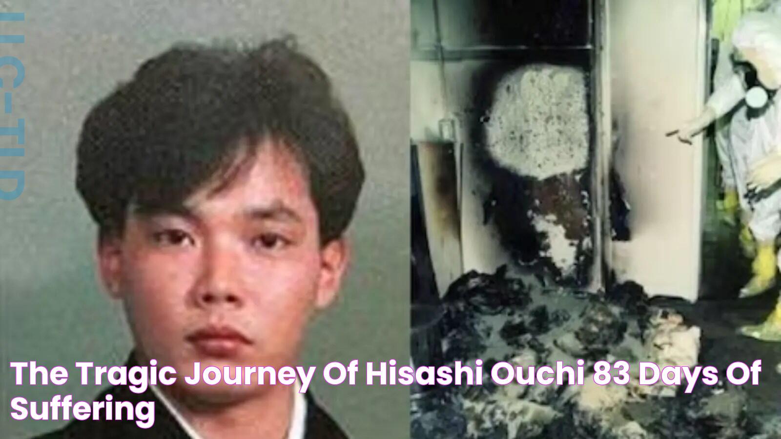 Unseen Hisashi Ouchi Photos: A Tragic Tale Of Radiation Exposure