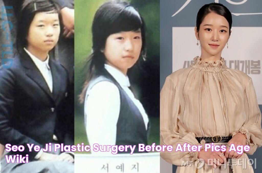 Seo Ye Ji Plastic Surgery, Before After Pics Age Wiki