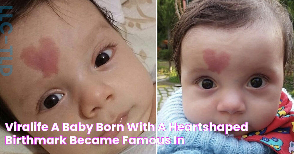 ViraLife A baby born with a heartshaped birthmark became famous in