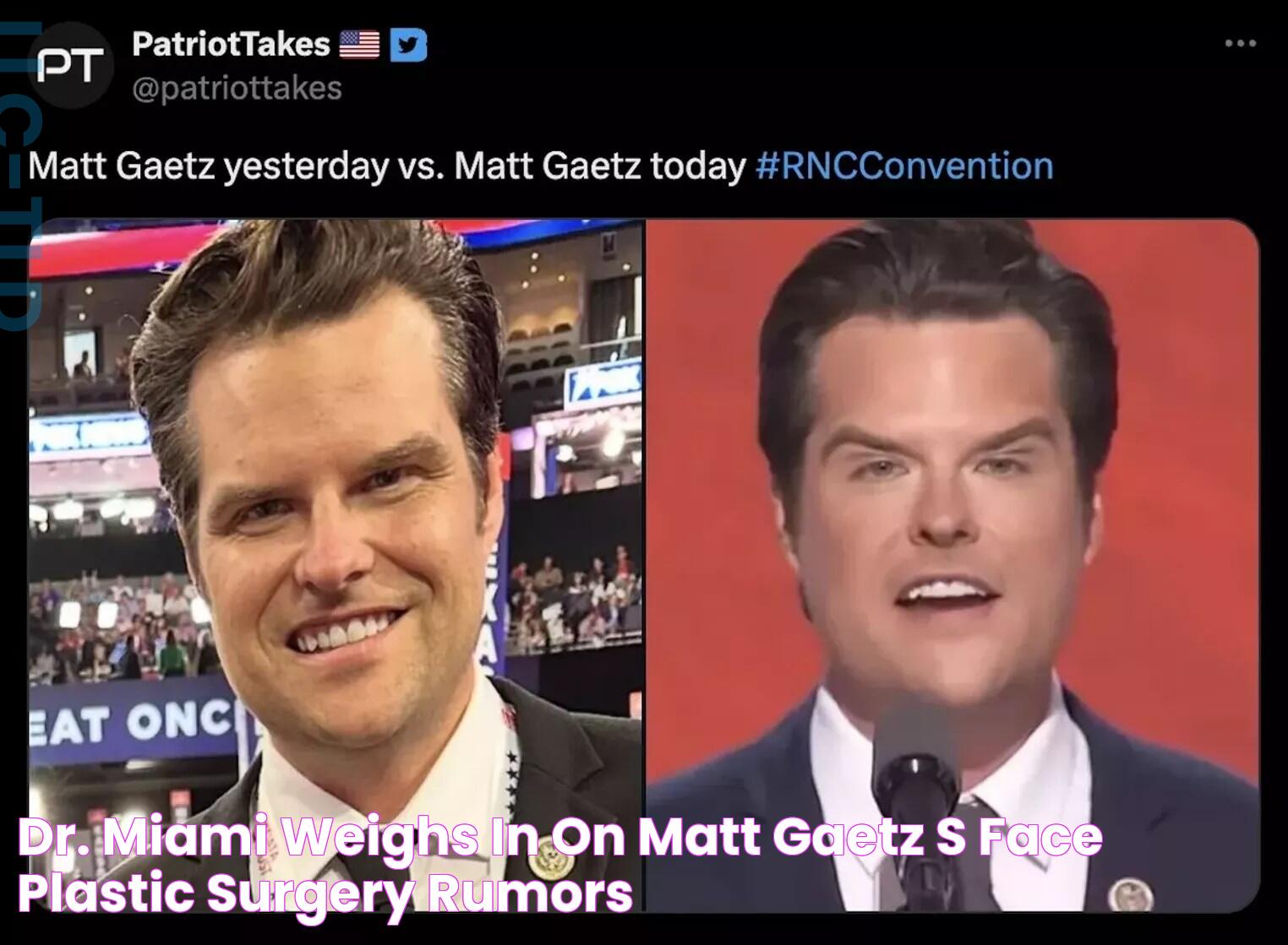 Dr. Miami Weighs In On Matt Gaetz’s Face, Plastic Surgery Rumors