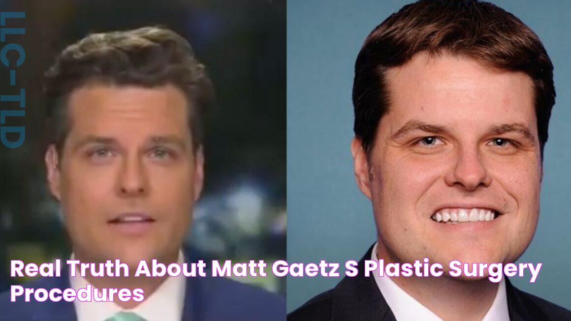 Discover The Truth: Matt Gaetz's Suspected Plastic Surgery Procedures Unveiled