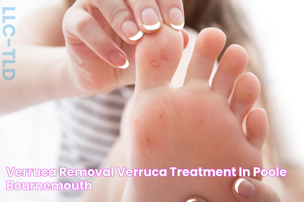 Verruca Removal & Verruca Treatment In Poole & Bournemouth