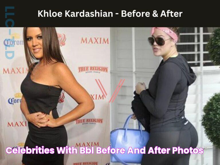 Celebrities with BBL Before and After Photos