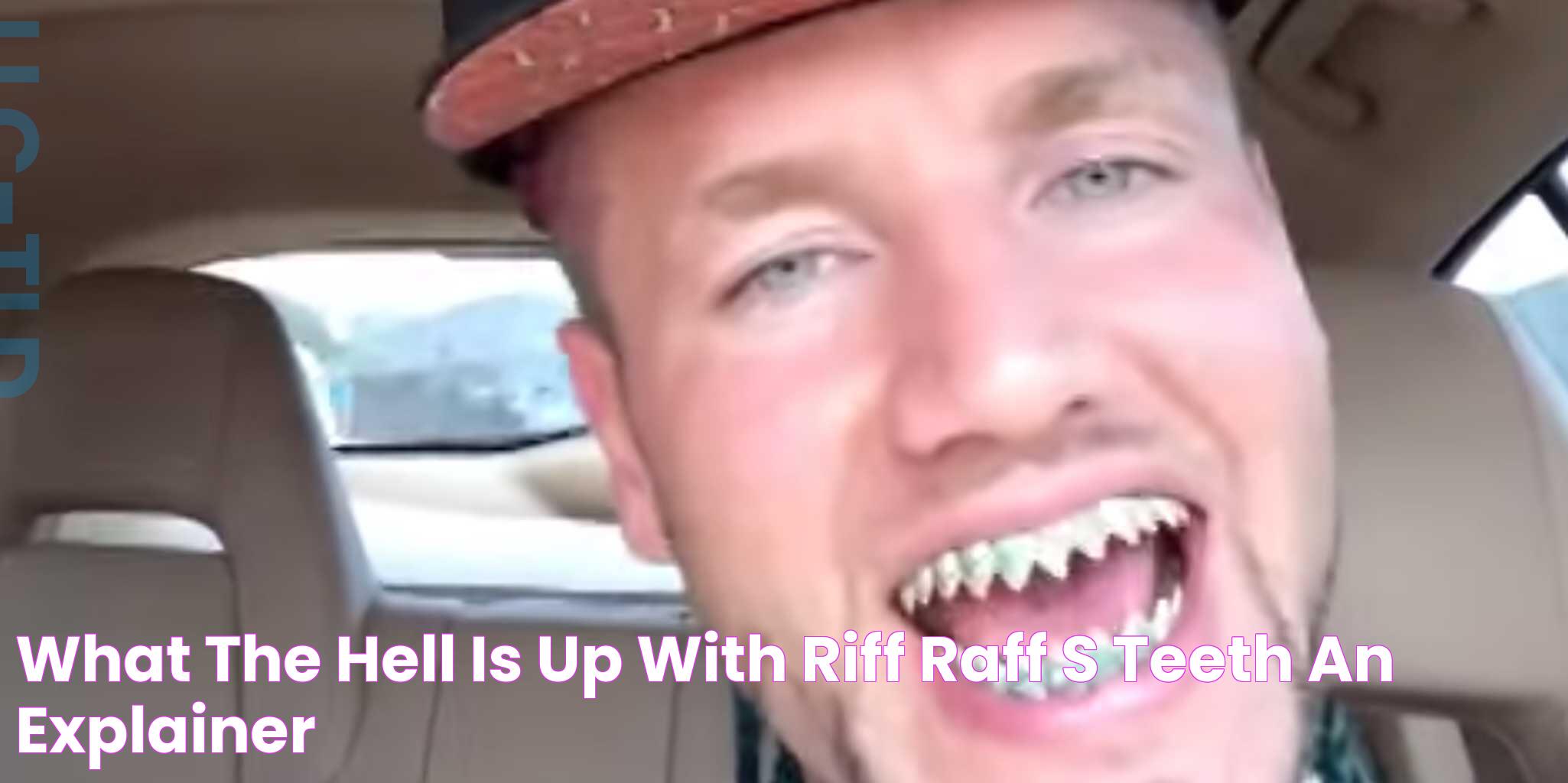 Brilliant Transformation: Riff Raff Teeth To Picture-Perfect Smiles