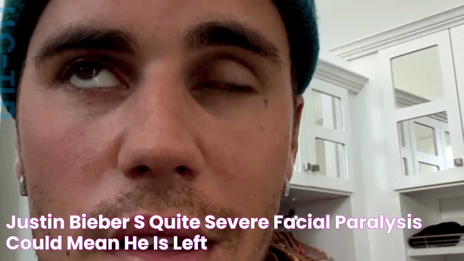 Justin Bieber's 'quite severe' facial paralysis could mean he is left